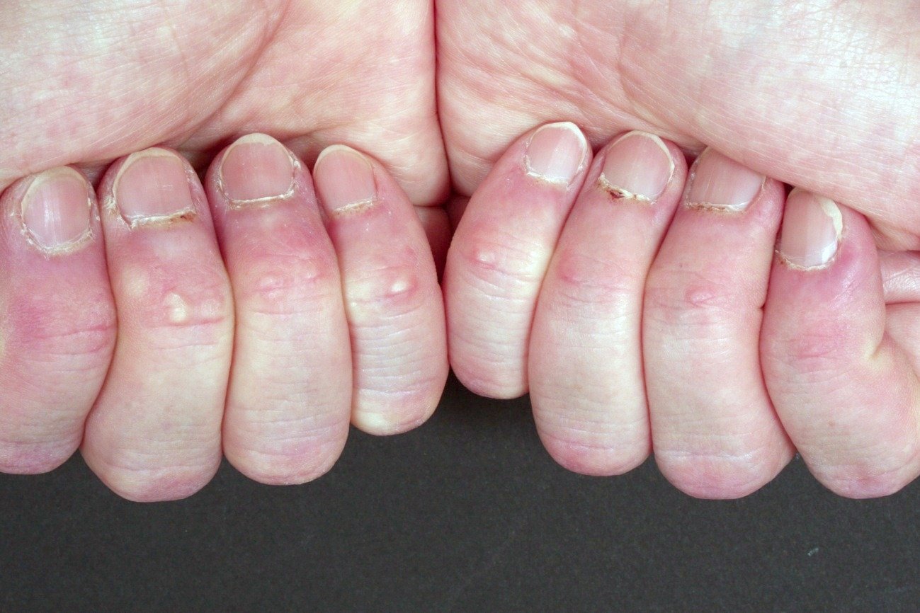 Collagen Disease Clinical Practice English 新潟大学大学院皮膚科学分野