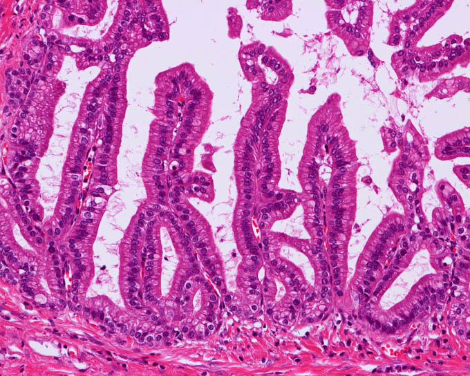 膵，膵管内乳頭粘液性腺腫 (Intraductal papillary mucinous adenoma)