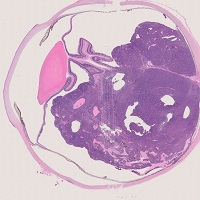 網膜芽細胞腫
