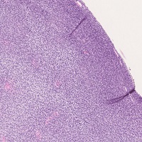 莢膜細胞腫