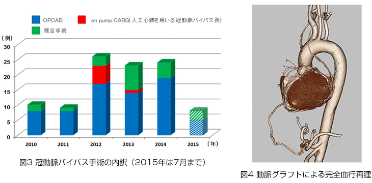 冠動脈バイパス手術の内訳グラフ