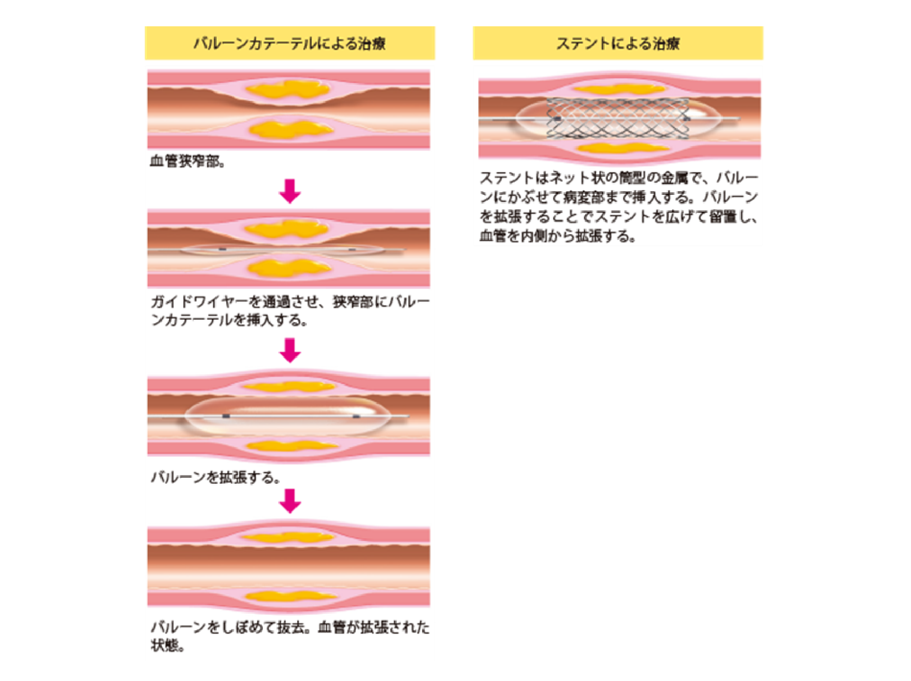 心臓血管形成術とステント留置術に関連するリスクは何ですか?
