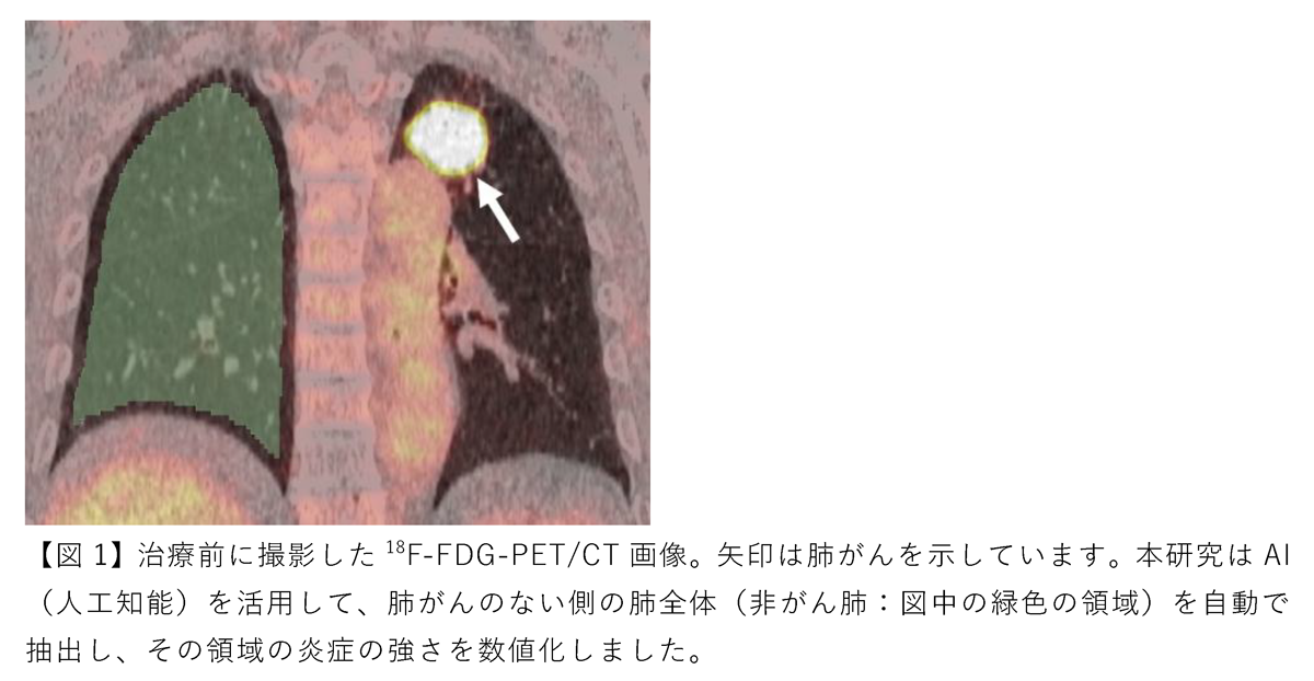 AI¤ò³èÍѤ·¤¿PET/CT²èÁü¤Î²òÀϤÇÇÙ¤¬¤óÌȱÖÎÅË¡¤ÎÉûºîÍѤȼ£ÎŸå¤Î·Ð²á¤òͽ¬ ¡Ý´µ¼Ô°ì¿Í°ì¿Í¤ËŬ¤·¤¿¼£ÎÅ¡¢·Ð²á´Ñ»¡¤ÎÊýË¡¤Îȯ¸«¤Ë´óÍ¿¡Ý