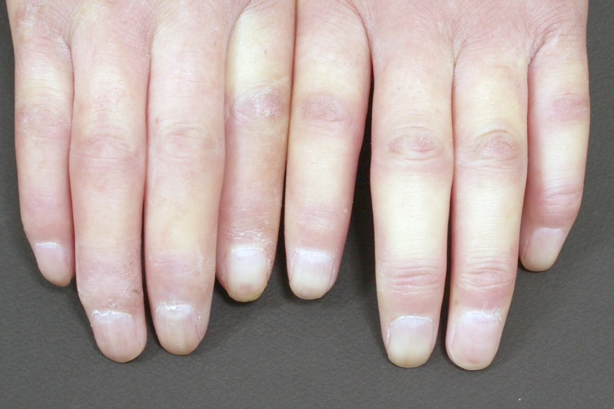 Collagen Disease