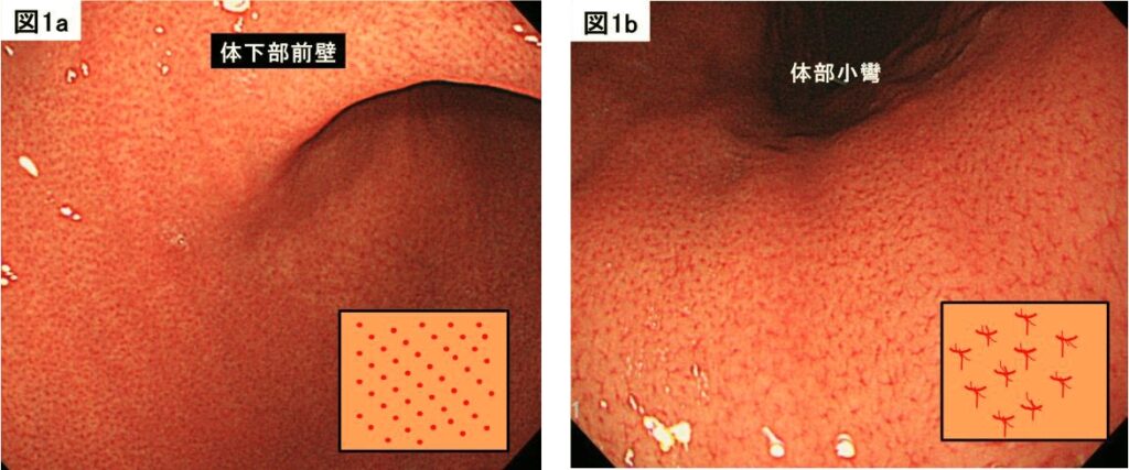 胃粘膜 ‐胃炎と胃癌‐の拡大内視鏡診断の紹介