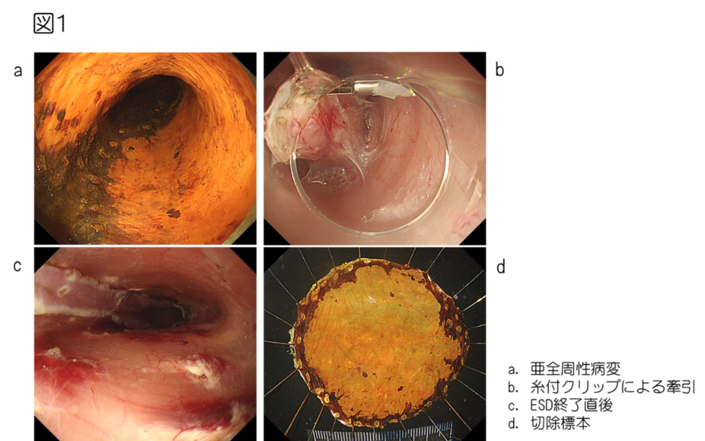 広汎食道表在癌に対するESD手技の工夫と狭窄予防対策