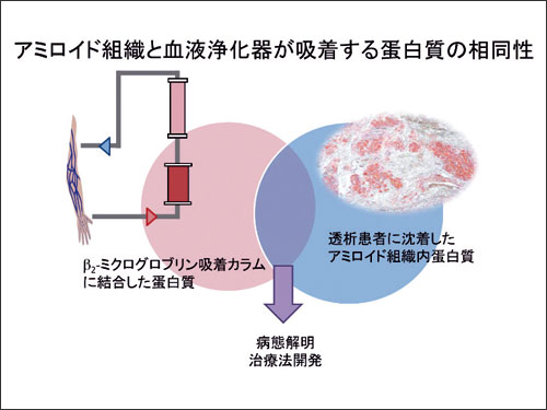 アミロイド組織と血液浄化器が吸着する蛋白質の相同性