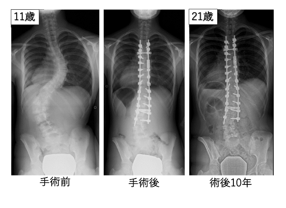 図6:思春期特発性側弯症に対する後方矯正固定術
