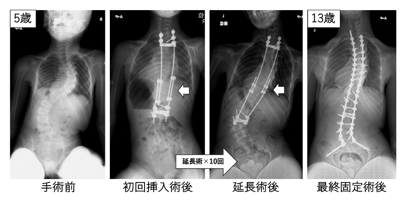 図7:早期発症側弯症に対する成長温存術 (グローイングロッド法)