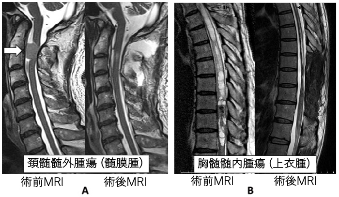 図8：脊髄腫瘍摘出術