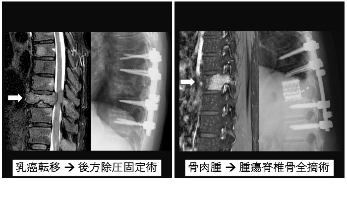 図9：脊椎腫瘍に対する姑息的手術と根治的手術
