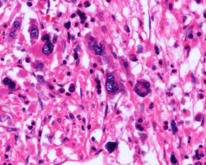 骨髄，骨髄線維症 (Myelofibrosis)