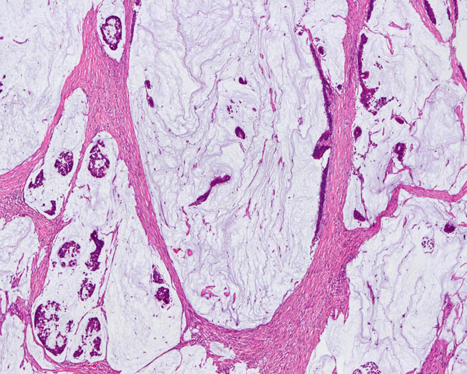 病理標本 大腸 粘液癌 分化型 新潟大学医学部臨床病理学分野い