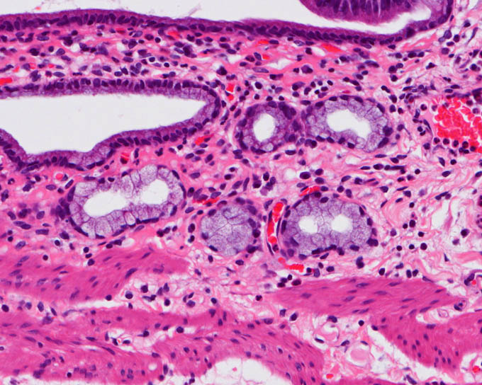 胆嚢，幽門腺化生（Pyloric gland metaplasia）