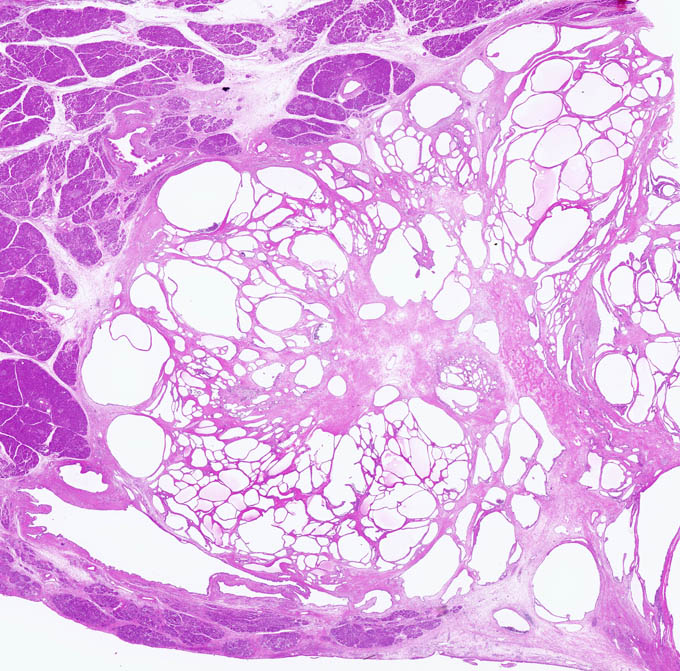 膵臓，漿液性嚢胞腺腫