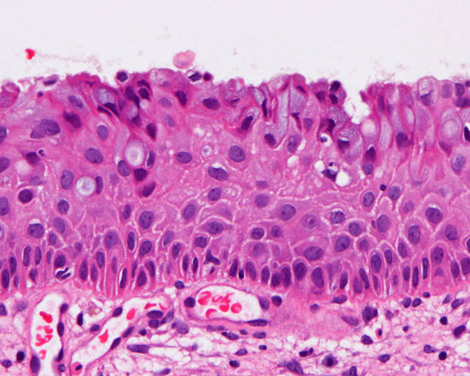 子宮頸部，扁平上皮化生（Squamous metaplasia）