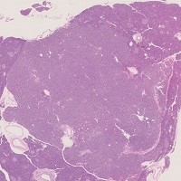 insulinoma